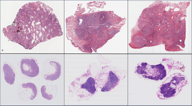 Figure 1 for Clustered Patch Embeddings for Permutation-Invariant Classification of Whole Slide Images