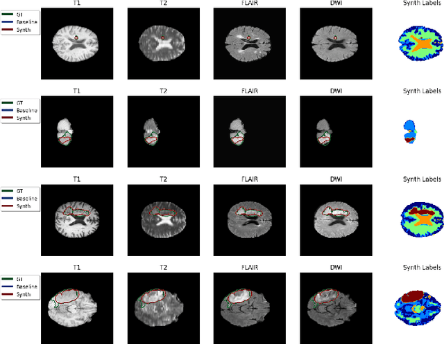 Figure 4 for Synthetic Data for Robust Stroke Segmentation