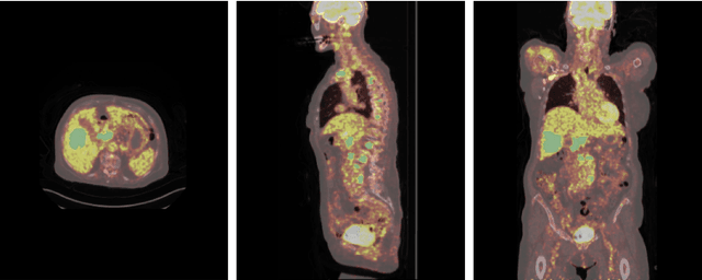 Figure 2 for Anatomy-Aware Lymphoma Lesion Detection in Whole-Body PET/CT