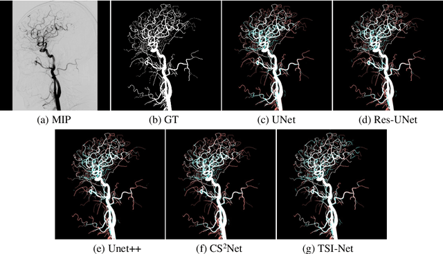 Figure 3 for TSI-Net: A Timing Sequence Image Segmentation Network for Intracranial Artery Segmentation in Digital Subtraction Angiography