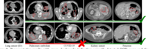 Figure 3 for Random forest-based out-of-distribution detection for robust lung cancer segmentation