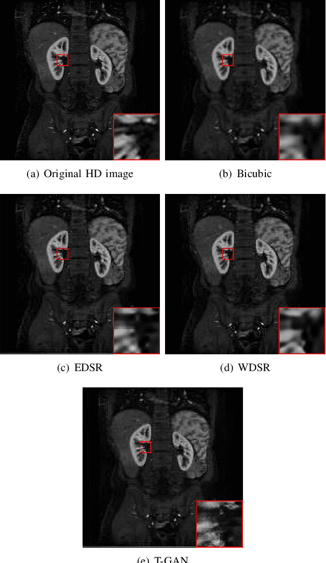Figure 4 for Transformer and GAN Based Super-Resolution Reconstruction Network for Medical Images