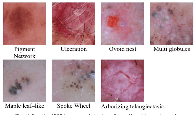 Figure 1 for Concordance in basal cell carcinoma diagnosis. Building a proper ground truth to train Artificial Intelligence tools