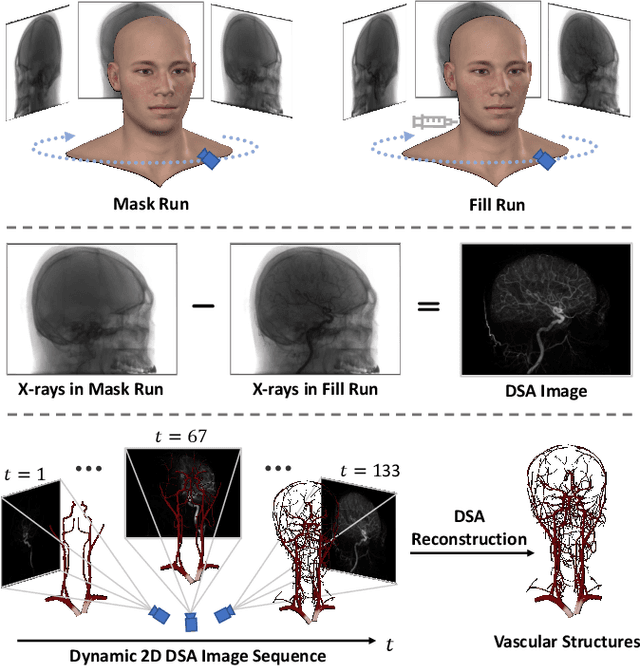 Figure 1 for 3D Vessel Reconstruction from Sparse-View Dynamic DSA Images via Vessel Probability Guided Attenuation Learning