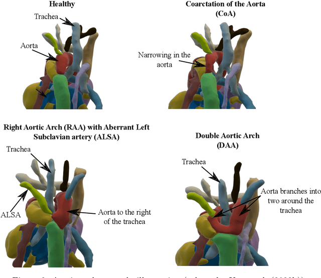 Figure 3 for Multi-task learning for joint weakly-supervised segmentation and aortic arch anomaly classification in fetal cardiac MRI