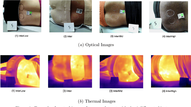 Figure 1 for Is thermography a viable solution for detecting pressure injuries in dark skin patients?