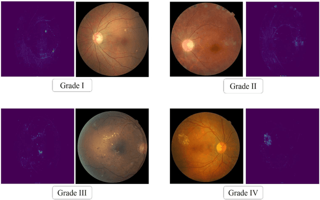 Figure 2 for Local-to-Global Self-Supervised Representation Learning for Diabetic Retinopathy Grading