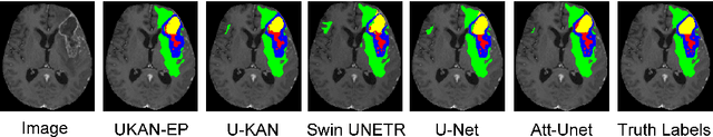 Figure 4 for 3D U-KAN Implementation for Multi-modal MRI Brain Tumor Segmentation
