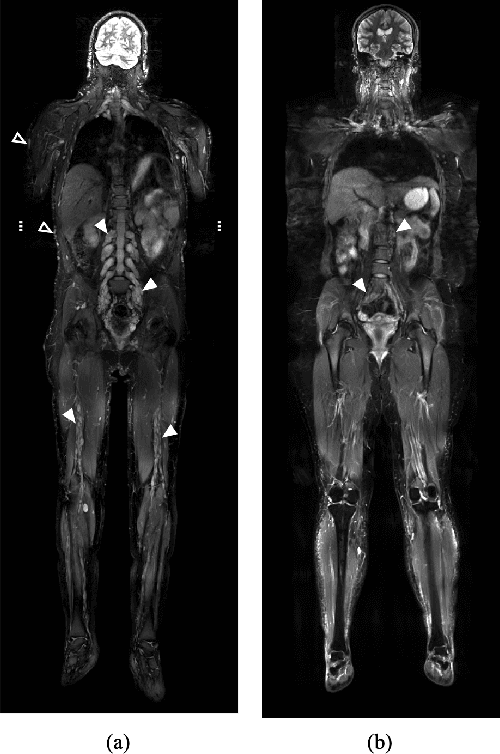Figure 1 for Anatomy-Informed Deep Learning and Radiomics for Automated Neurofibroma Segmentation in Whole-Body MRI