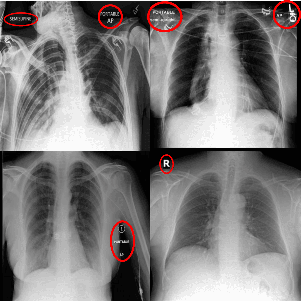 Figure 3 for Understanding Dataset Bias in Medical Imaging: A Case Study on Chest X-rays