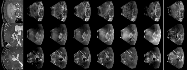 Figure 3 for Learning to Match 2D Keypoints Across Preoperative MR and Intraoperative Ultrasound