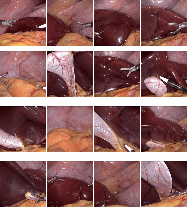 Figure 3 for SimuScope: Realistic Endoscopic Synthetic Dataset Generation through Surgical Simulation and Diffusion Models