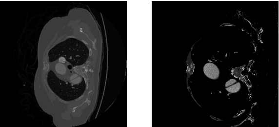 Figure 2 for Semi-Supervised 3D Segmentation for Type-B Aortic Dissection with Slim UNETR