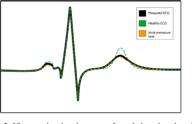 Figure 3 for Explainable AI (XAI) for Arrhythmia detection from electrocardiograms