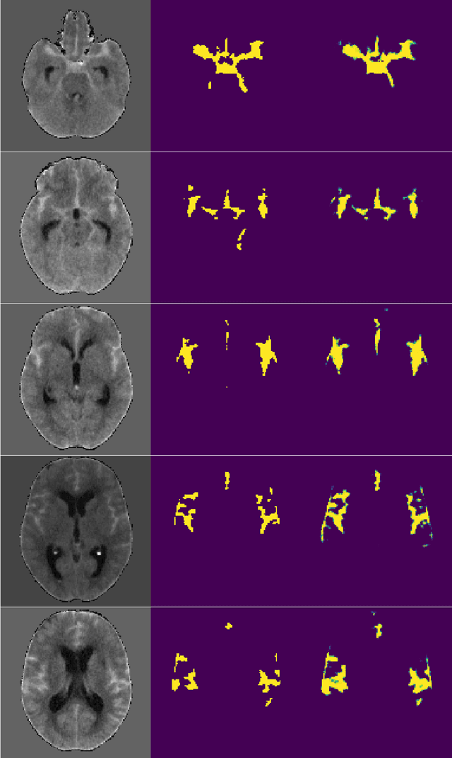 Figure 4 for A Fully Automated Pipeline Using Swin Transformers for Deep Learning-Based Blood Segmentation on Head CT Scans After Aneurysmal Subarachnoid Hemorrhage