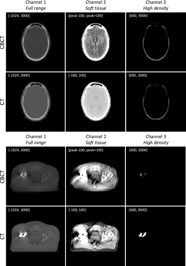 Figure 3 for A multi-channel cycleGAN for CBCT to CT synthesis