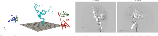 Figure 1 for 3D/2D Registration of Angiograms using Silhouette-based Differentiable Rendering
