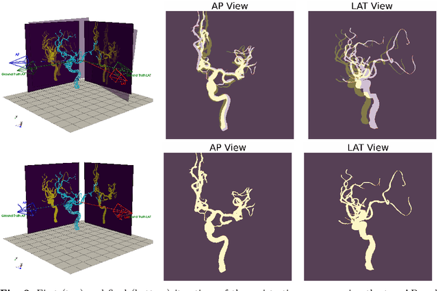 Figure 3 for 3D/2D Registration of Angiograms using Silhouette-based Differentiable Rendering