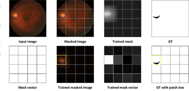 Figure 1 for Hierarchical Salient Patch Identification for Interpretable Fundus Disease Localization