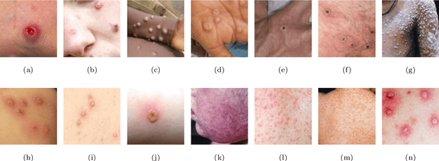 Figure 1 for An Explainable Nature-Inspired Framework for Monkeypox Diagnosis: Xception Features Combined with NGBoost and African Vultures Optimization Algorithm