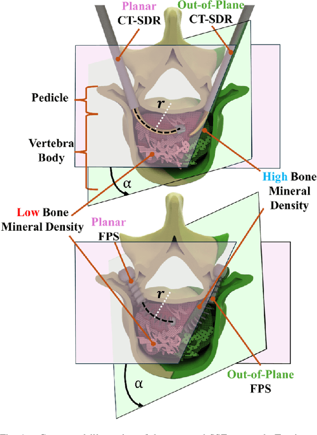 Figure 1 for Spatial Spinal Fixation: A Transformative Approach Using a Unique Robot-Assisted Steerable Drilling System and Flexible Pedicle Screw