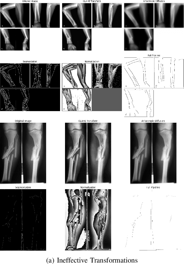 Figure 1 for Bone Fracture Classification using Transfer Learning