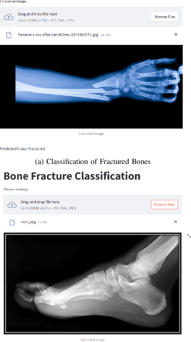 Figure 3 for Bone Fracture Classification using Transfer Learning