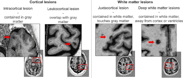 Figure 1 for Explainability of AI Uncertainty: Application to Multiple Sclerosis Lesion Segmentation on MRI