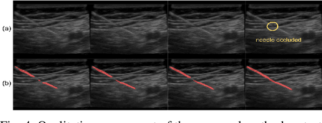 Figure 4 for Motion Informed Needle Segmentation in Ultrasound Images