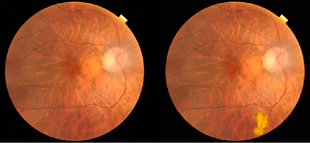 Figure 3 for Developing Explainable Machine Learning Model using Augmented Concept Activation Vector