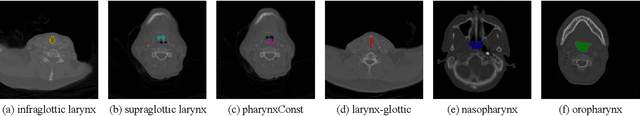 Figure 1 for Topology-Aware Wavelet Mamba for Airway Structure Segmentation in Postoperative Recurrent Nasopharyngeal Carcinoma CT Scans