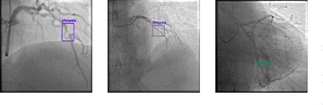 Figure 1 for Evaluating Stenosis Detection with Grounding DINO, YOLO, and DINO-DETR