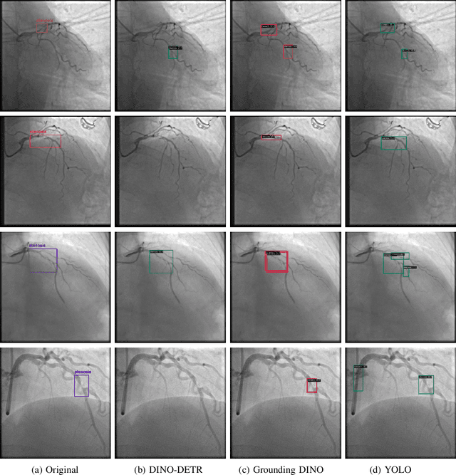 Figure 2 for Evaluating Stenosis Detection with Grounding DINO, YOLO, and DINO-DETR