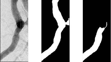 Figure 1 for Dr-SAM: An End-to-End Framework for Vascular Segmentation, Diameter Estimation, and Anomaly Detection on Angiography Images