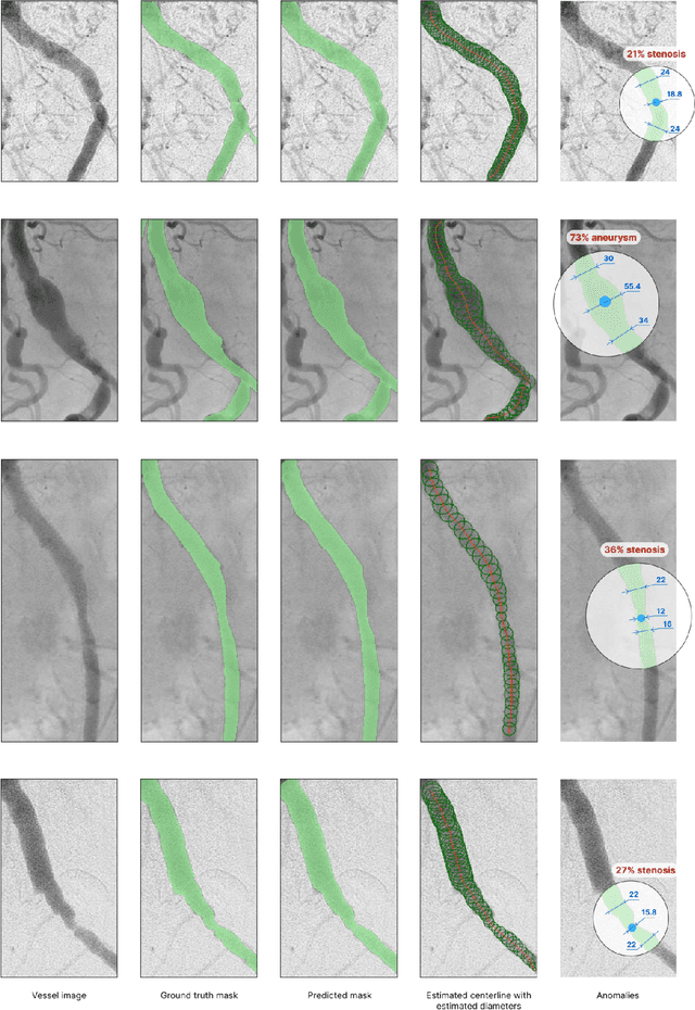 Figure 4 for Dr-SAM: An End-to-End Framework for Vascular Segmentation, Diameter Estimation, and Anomaly Detection on Angiography Images
