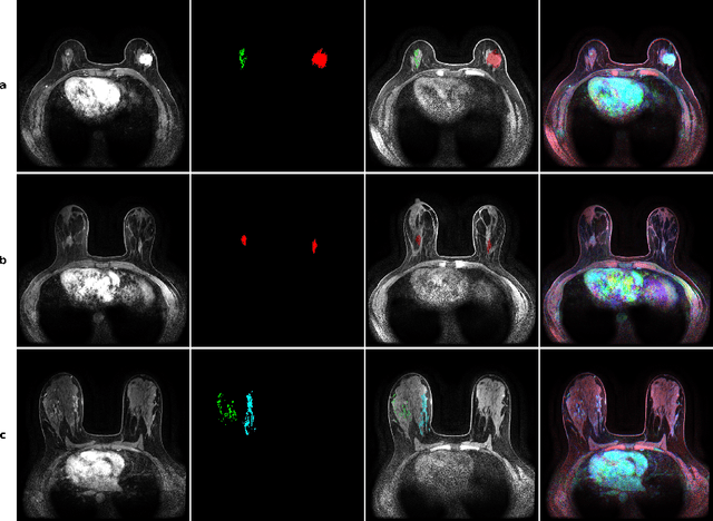 Figure 2 for Transformer Classification of Breast Lesions: The BreastDCEDL_AMBL Benchmark Dataset and 0.92 AUC Baseline
