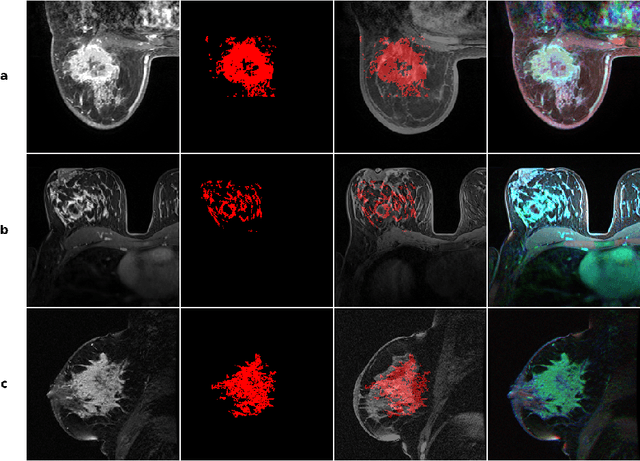 Figure 4 for Transformer Classification of Breast Lesions: The BreastDCEDL_AMBL Benchmark Dataset and 0.92 AUC Baseline