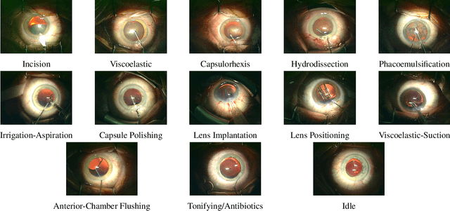 Figure 1 for Cataract-1K: Cataract Surgery Dataset for Scene Segmentation, Phase Recognition, and Irregularity Detection