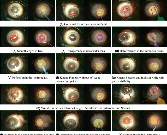 Figure 4 for Cataract-1K: Cataract Surgery Dataset for Scene Segmentation, Phase Recognition, and Irregularity Detection