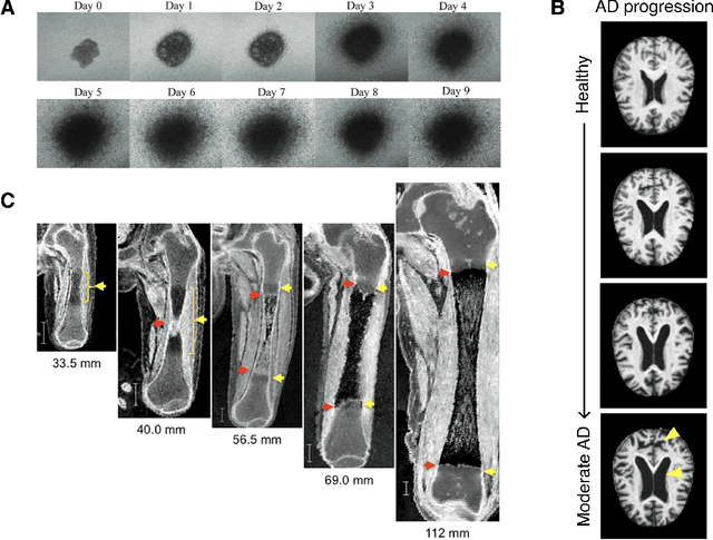 Figure 1 for Shape Modeling of Longitudinal Medical Images: From Diffeomorphic Metric Mapping to Deep Learning