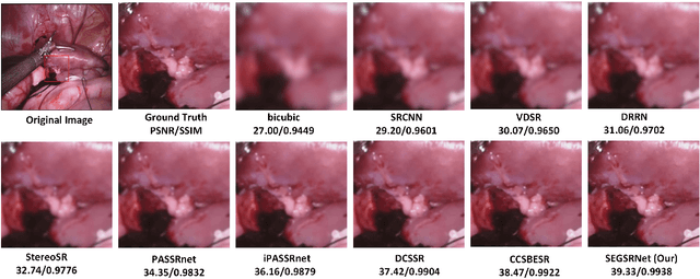 Figure 3 for SEGSRNet for Stereo-Endoscopic Image Super-Resolution and Surgical Instrument Segmentation