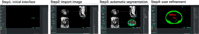 Figure 2 for AI-Driven Automated Tool for Abdominal CT Body Composition Analysis in Gastrointestinal Cancer Management