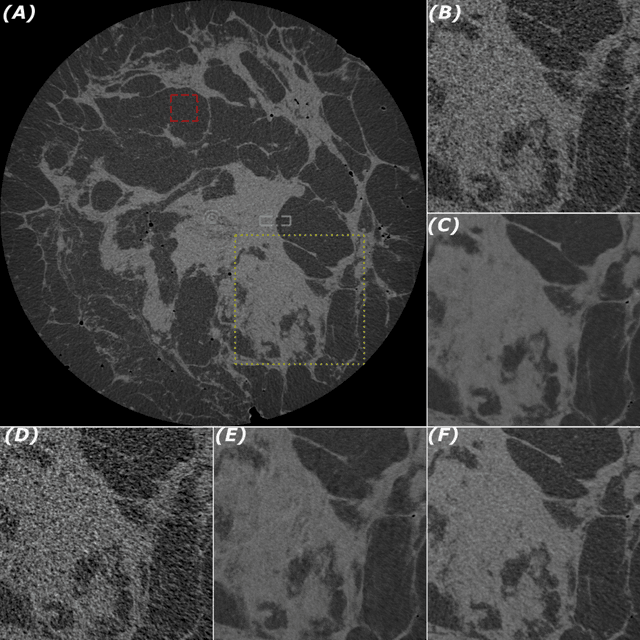Figure 1 for Towards order of magnitude X-ray dose reduction in breast cancer imaging using phase contrast and deep denoising