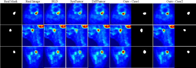 Figure 4 for TumorGen: Boundary-Aware Tumor-Mask Synthesis with Rectified Flow Matching