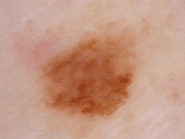 Figure 1 for A Study of Acquisition Functions for Medical Imaging Deep Active Learning