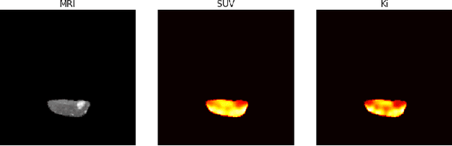 Figure 3 for Multimodal Deep Learning to Differentiate Tumor Recurrence from Treatment Effect in Human Glioblastoma
