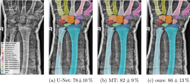 Figure 4 for SAM Carries the Burden: A Semi-Supervised Approach Refining Pseudo Labels for Medical Segmentation