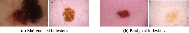 Figure 3 for Double-Condensing Attention Condenser: Leveraging Attention in Deep Learning to Detect Skin Cancer from Skin Lesion Images
