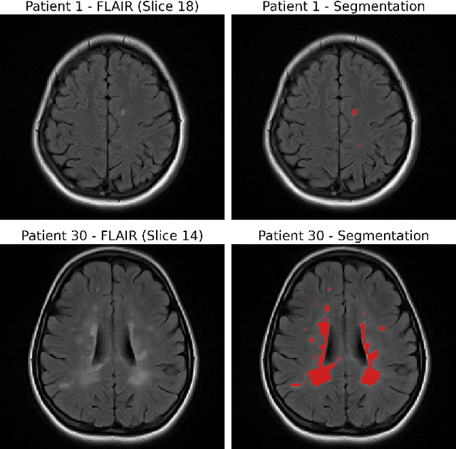 Figure 1 for Integrating Radiomics with Deep Learning Enhances Multiple Sclerosis Lesion Delineation
