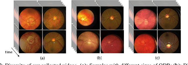 Figure 2 for RVD: A Handheld Device-Based Fundus Video Dataset for Retinal Vessel Segmentation